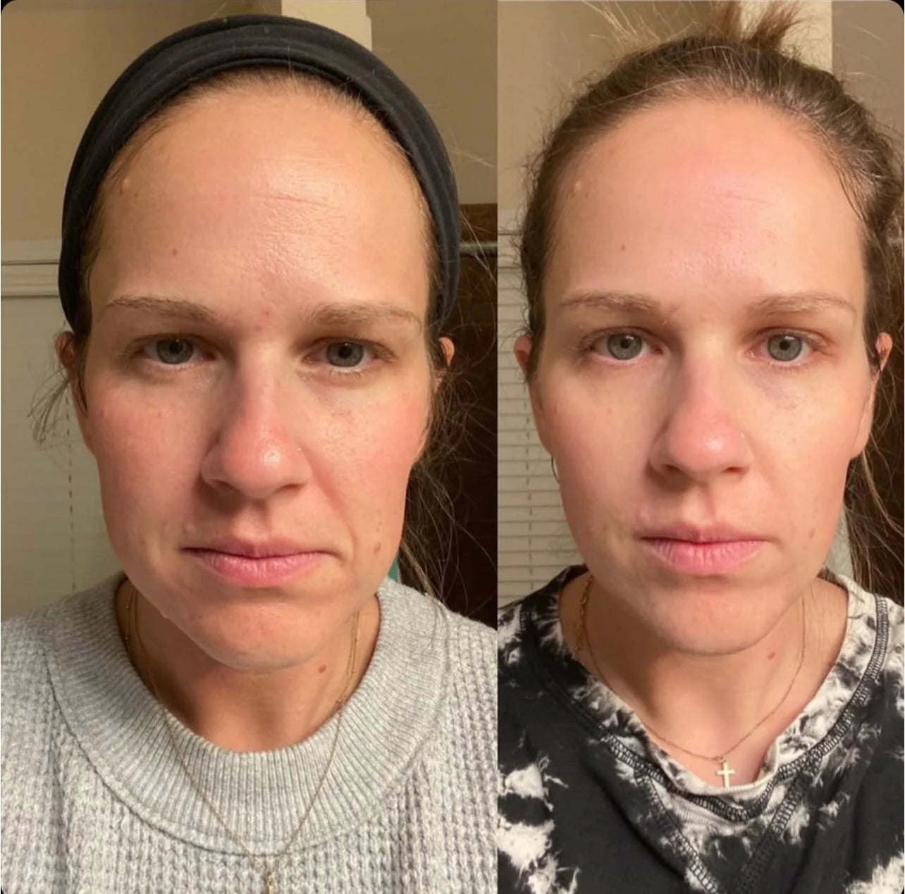 Elevé Tapes™ - Facial Lift Japanese Tapes - Botox Alternative | Anti-Wrinkle